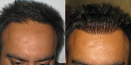 before and after hair transplant results in Chandigarh
