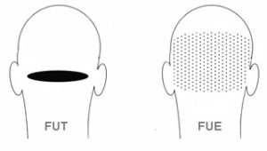 What are the different hair transplant methods and which one is the best?