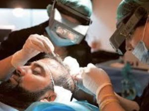 Hair transplant: what you did not know about it?