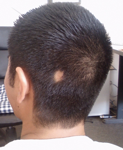 How is hair transplant getting safer in Punjab?