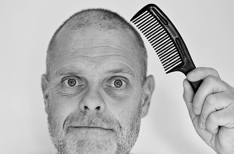 Who can go for hair transplant and at what age?