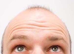 Top 7 things you must know before considering a hair transplant