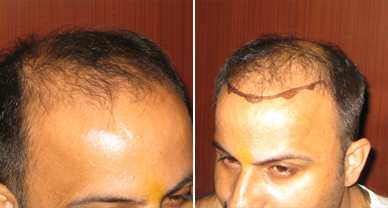 Hair Transplant in Chandigarh - Dr. Kalia's Novena Clinic