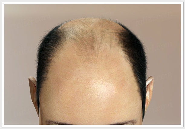 Hair Transplantation Stages & Grafts - Dr. Kalia's Novena Clinic