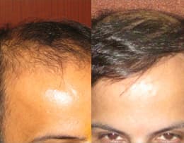 Hair Transplant in Chandigarh - Dr. Kalia's Novena Clinic