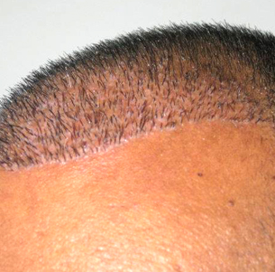 FUE Hair Transplant in India