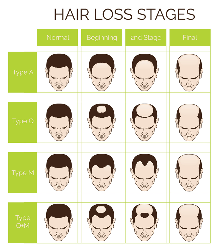 Hair Loss Treatment For Men - Dr. Kalia's Novena Clinic